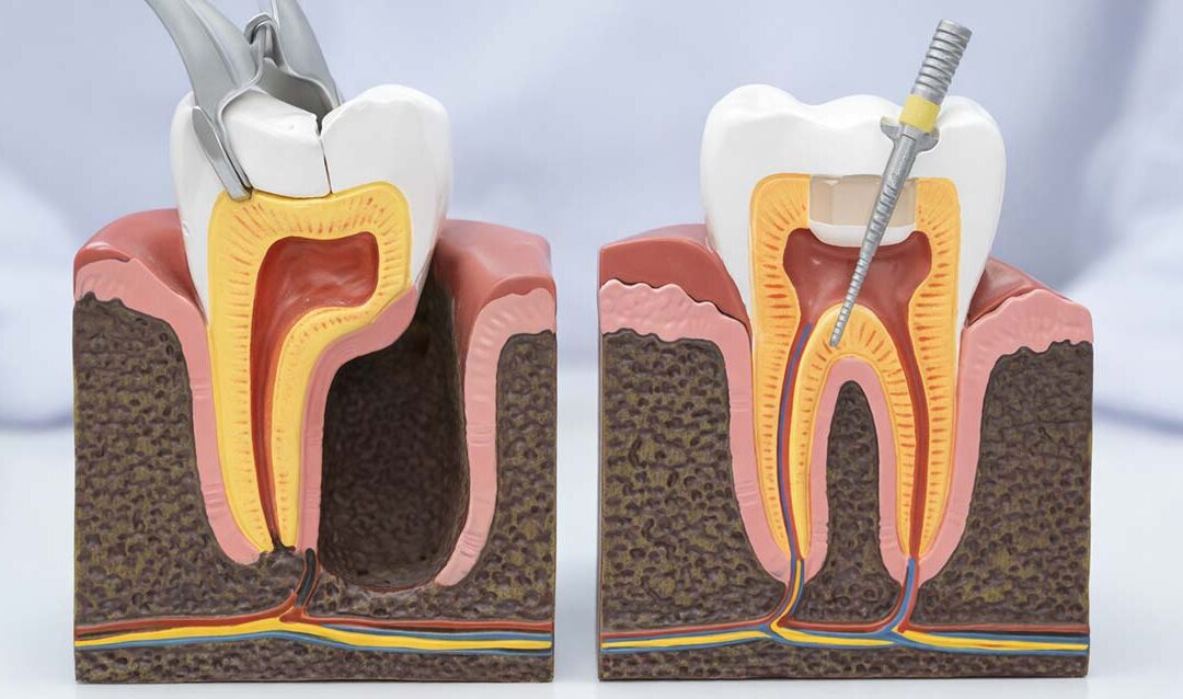 Tooth Extraction vs Root Canal: Which Treatment Is Right?
