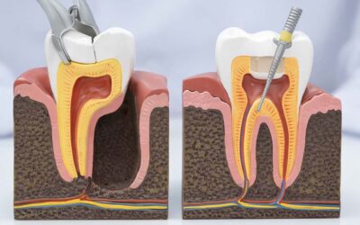 Tooth Extraction vs Root Canal: Which Treatment Is Right?