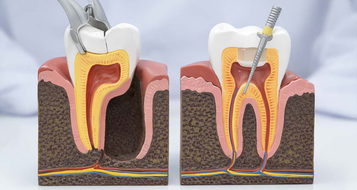 Tooth Extraction vs Root Canal img Tooth Extraction vs Root Canal img