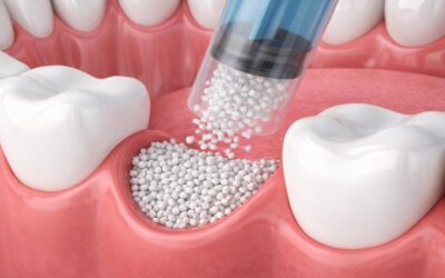 Why You May Need Bone Grafting Before Dental Implants