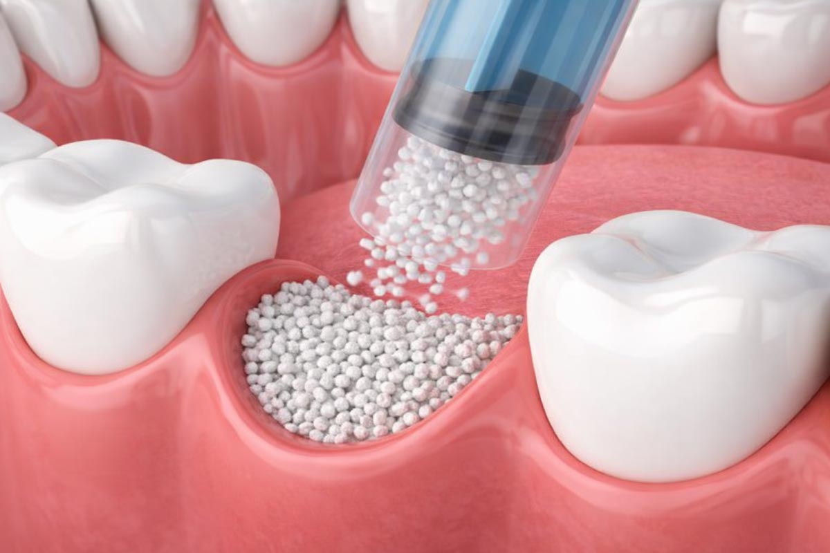 Image showing Bone Grafting
