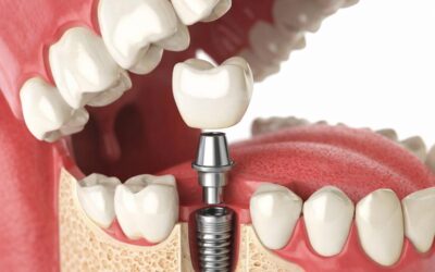 Are Dental Implants Worth It? Everything You Need to Know Before Replacing Missing Teeth