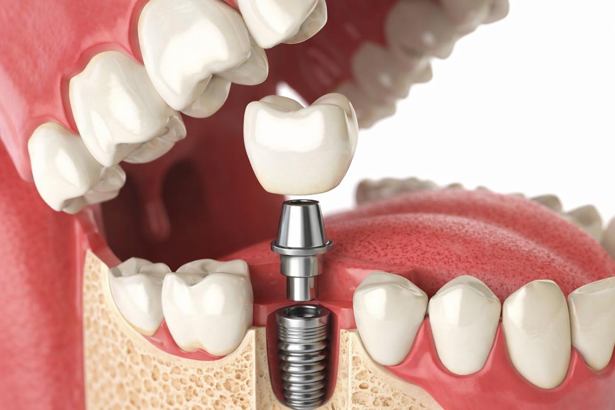 Image showing Dental Implants Image showing Dental Implants