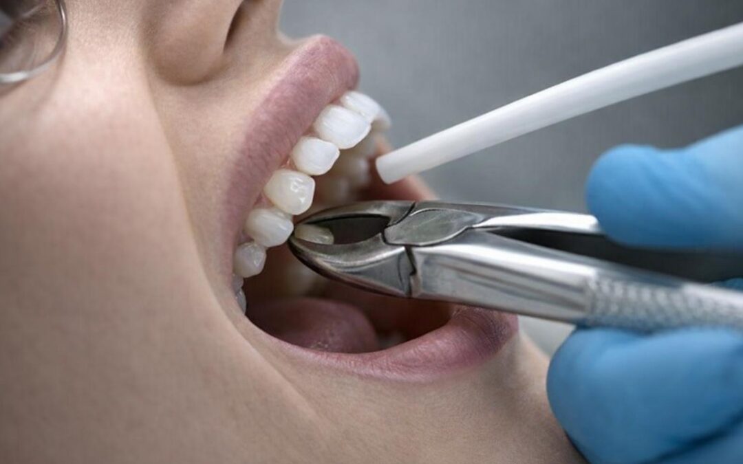 When Is a Tooth Extraction Necessary? What Every Patient Should Know