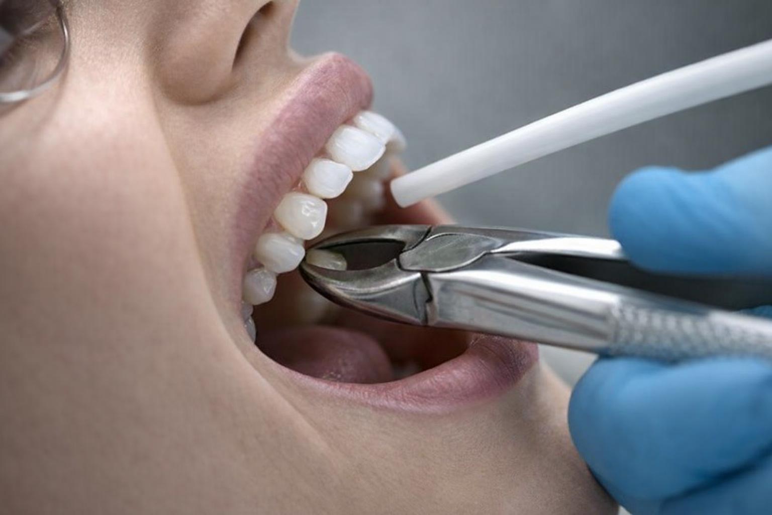 Image showing Tooth Extraction