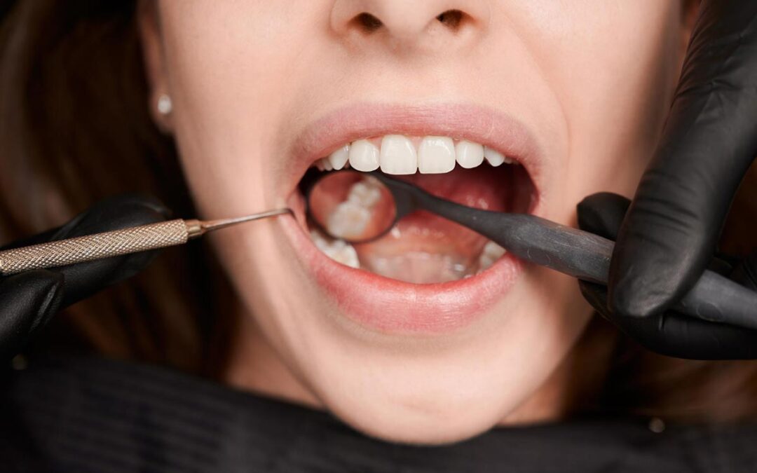 Crown Lengthening: Is It Cosmetic, Functional or Both?