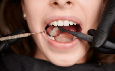 Crown Lengthening: Is It Cosmetic, Functional or Both?