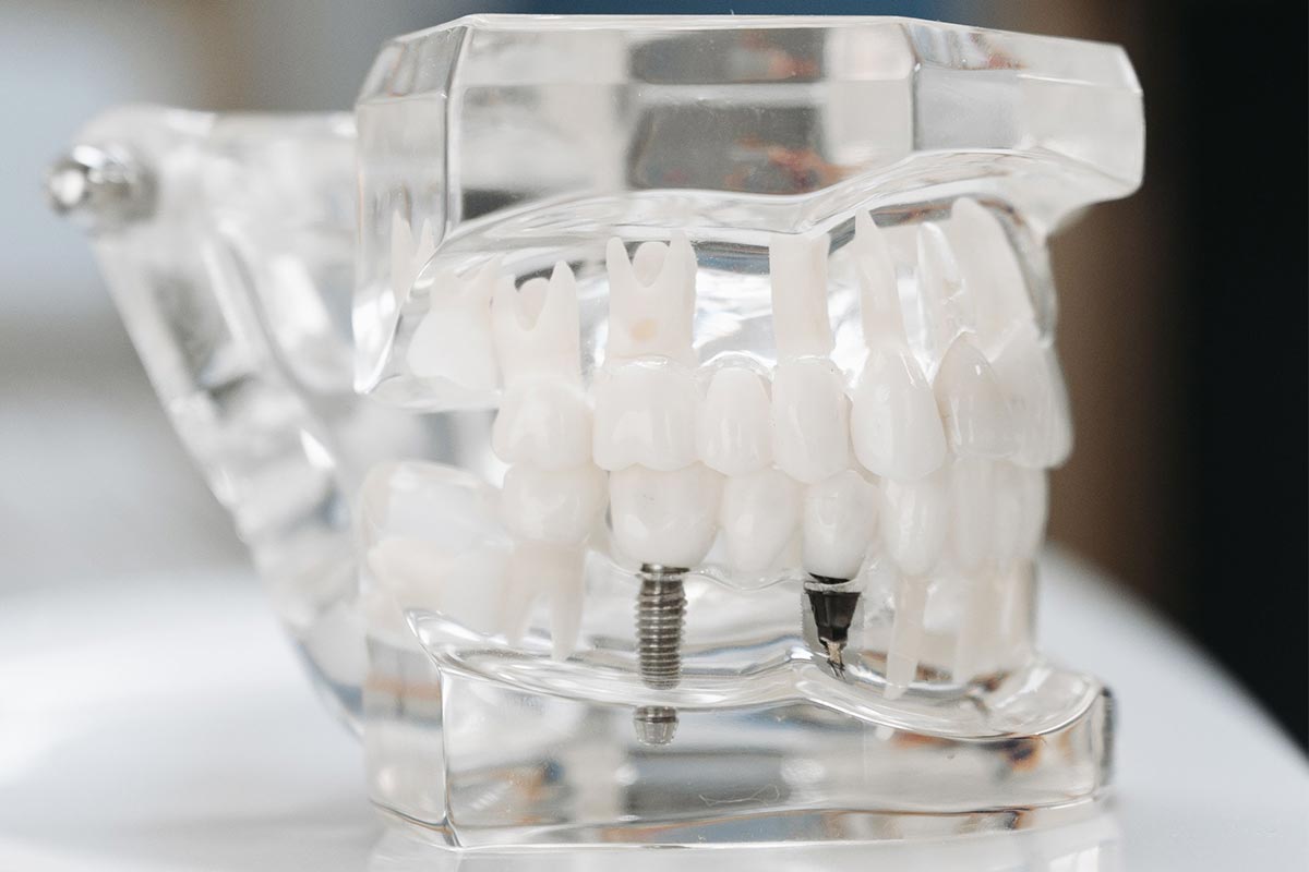hybrid implant bridge img
