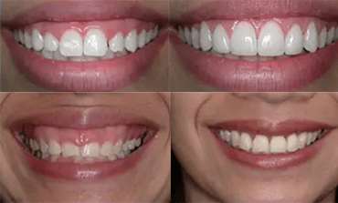 Crown Lengthening Before a Dental Crown: Why Is It Sometimes Necessary?