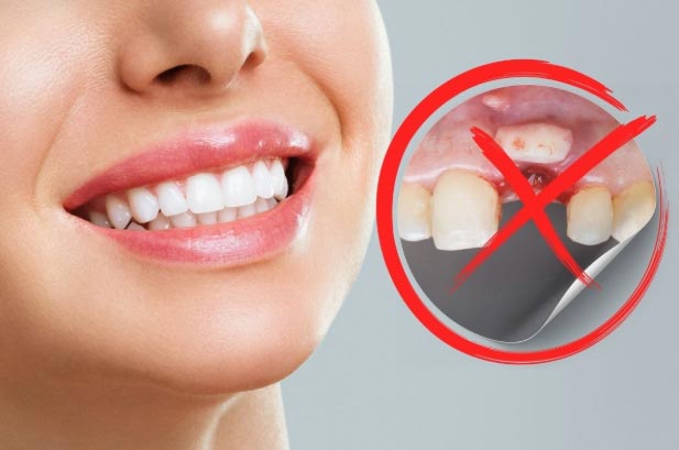 Gum Grafting img