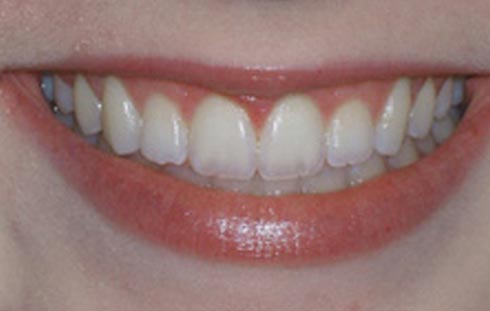 after crown lengthening