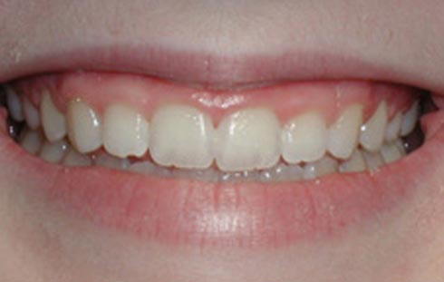 before crown lengthening