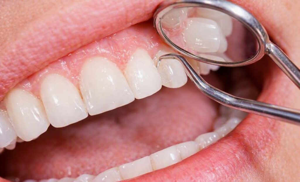 image Gum grafting