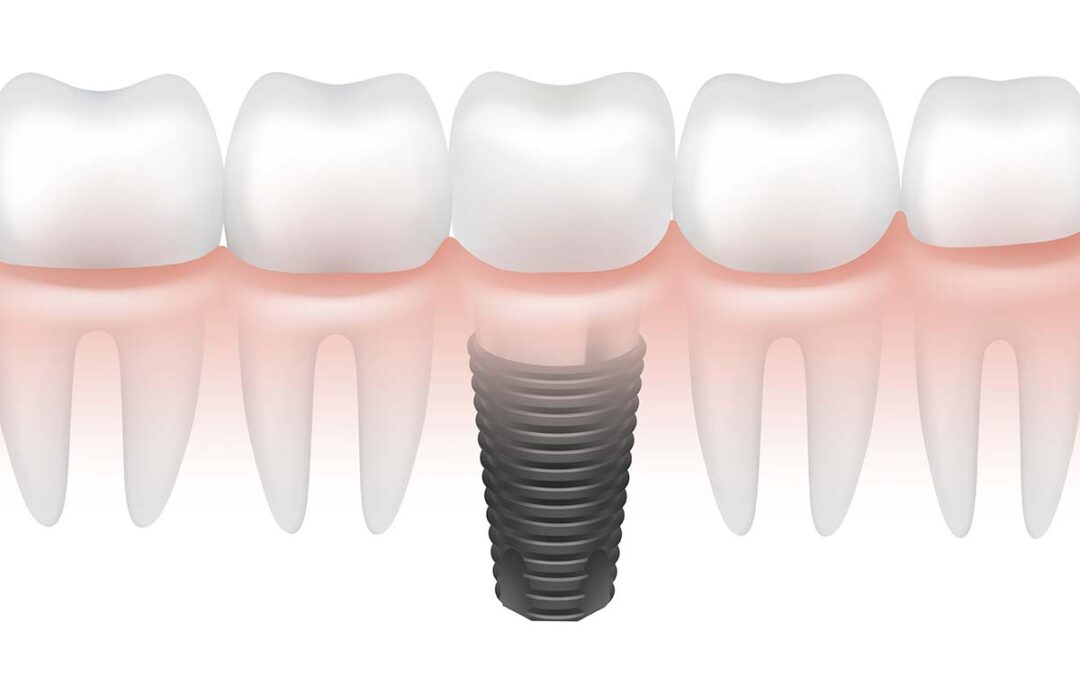Can You Get a Dental Implant Immediately After a Tooth Extraction?
