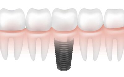 Can You Get a Dental Implant Immediately After a Tooth Extraction?