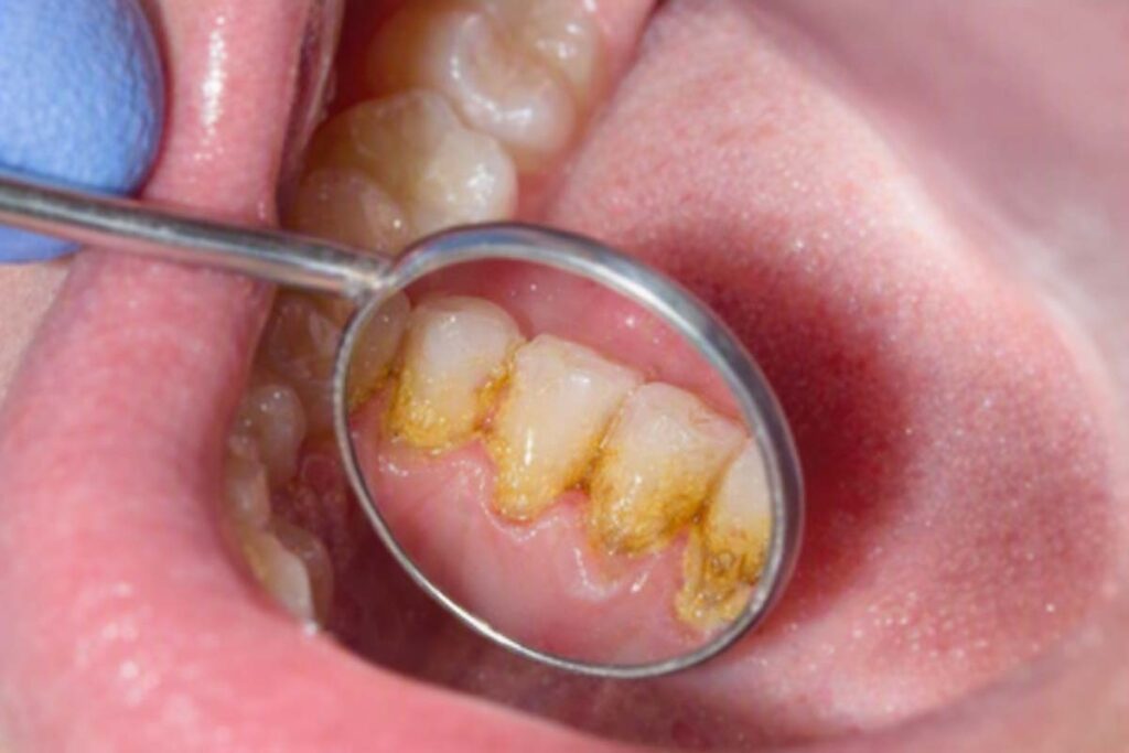 img Gum Disease
