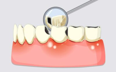 Can Gum Disease Be Reversed? Understanding Gingivitis and Periodontitis