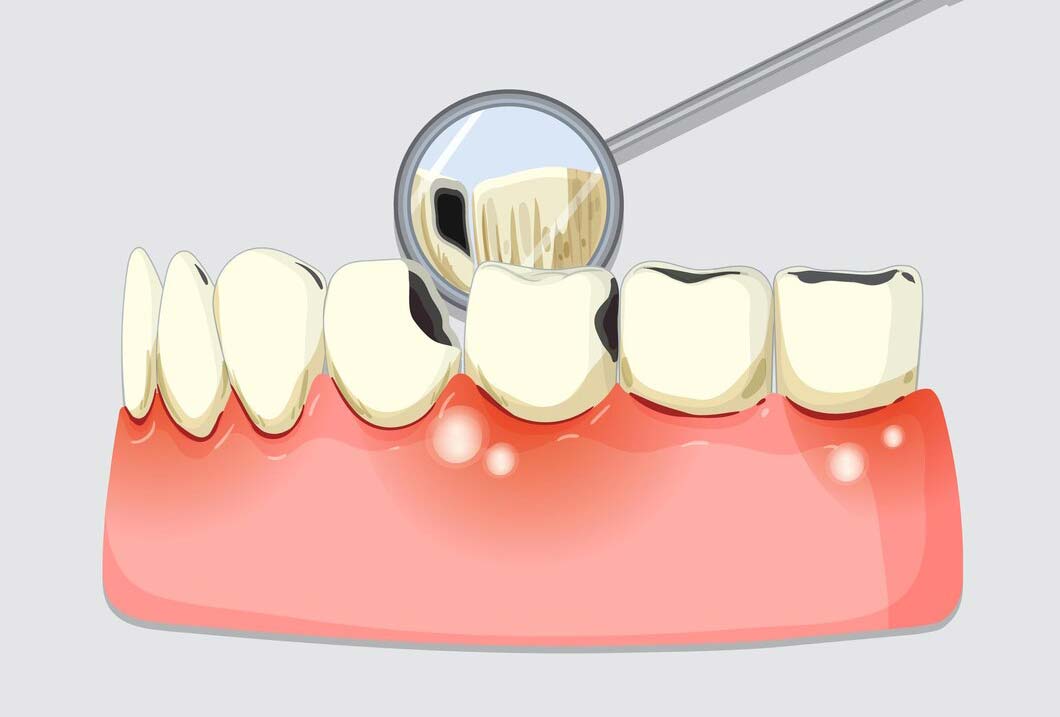 Gum Disease img Gum Disease img