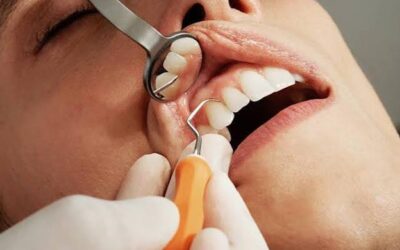 Why Are My Gums Receding? Causes, Risks and When to See a Periodontist