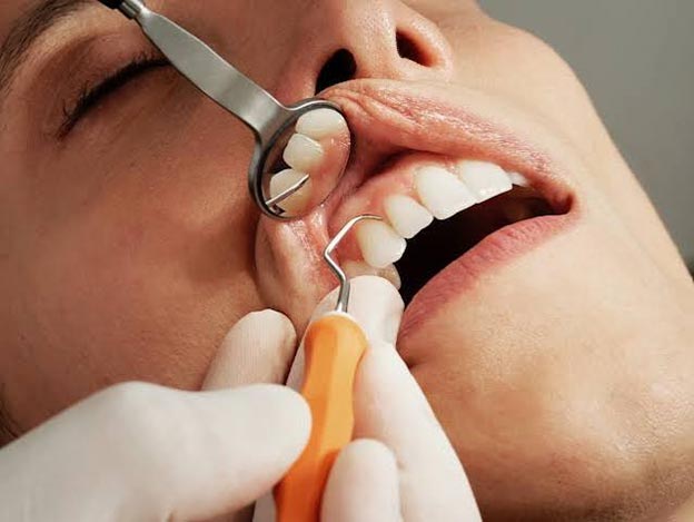Gums Receding img