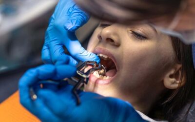 How Long After Tooth Extraction Does Bone Loss Begin?