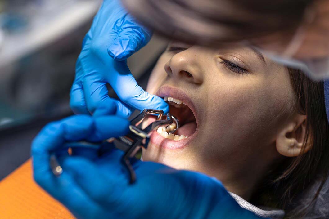 Tooth Extraction Does Bone Loss Begin img