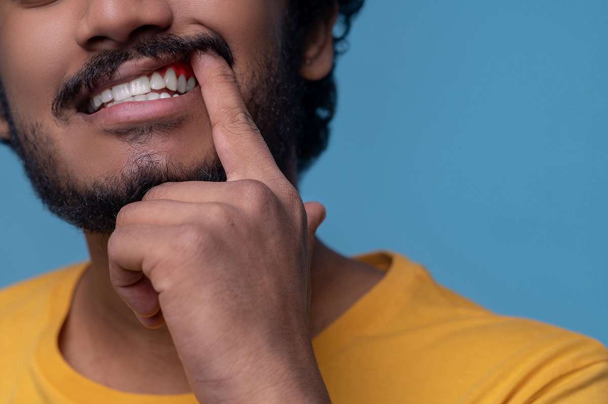 adult man showing his periodontal disease before camera