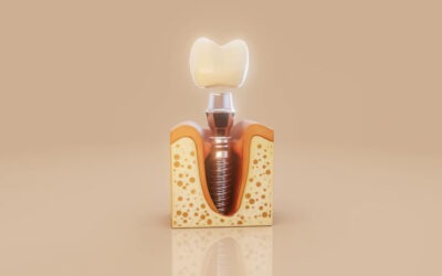 Dental Implant Maintenance: How to Protect Your Implant for the Long Term