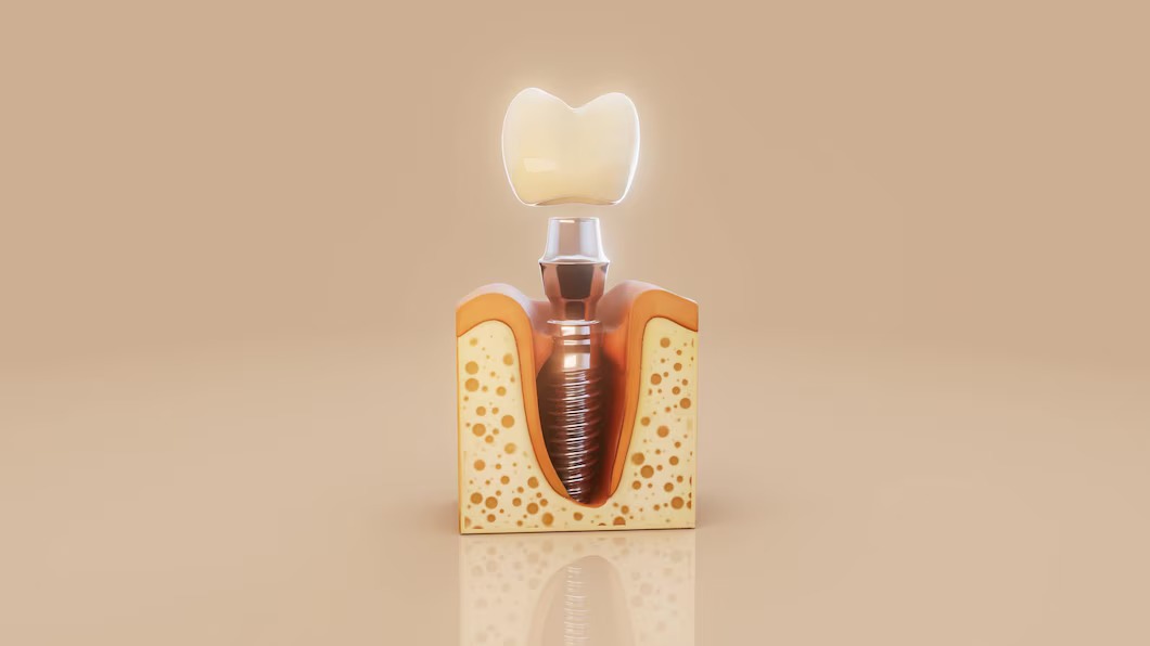 dental implant inside jawbone img dental implant inside jawbone img